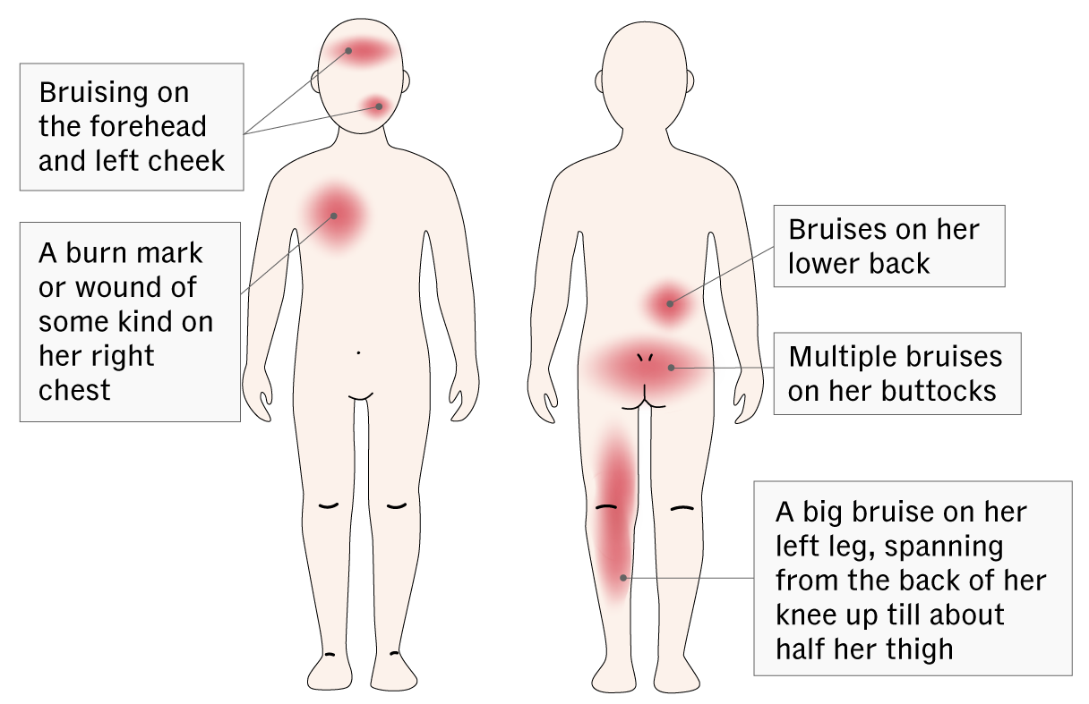 Diagram showing front and back outlines of Megan Khung’s body with red marks indicating bruises and wounds on the face, chest, back, buttocks, and leg.